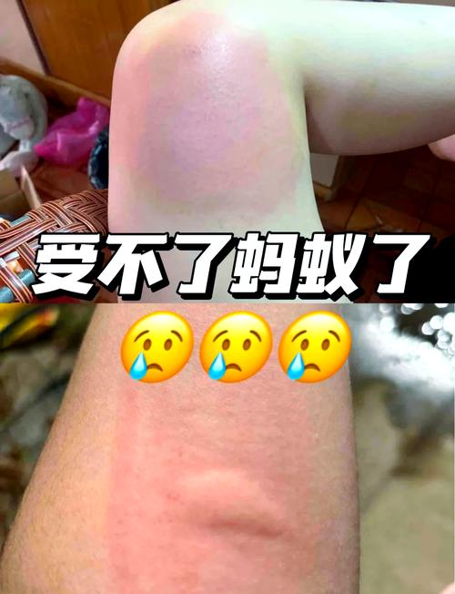 一般来说蚊子叮人蚂蚁庄园有哪些坑?(避开这4个常见误区就安全)